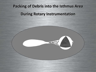 Packing of Debris into the Isthmus Area During Rotary Instrumentation 