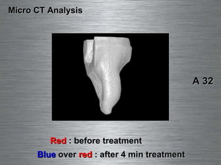 Micro CT Analysis Red  : before treatment Blue  over  red  : after 4 min treatment A 32 