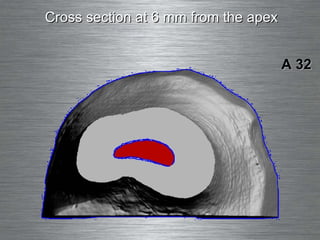 Cross section at 6 mm from the apex A 32 
