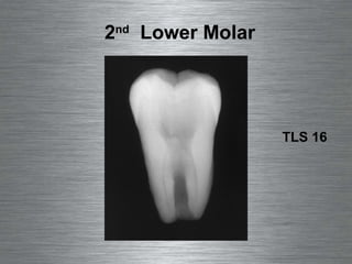 2 nd   Lower Molar TLS 16 