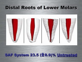 Distal Roots of Lower Molars SAF System 23.5 ( ± 8.9)%  Untreated 