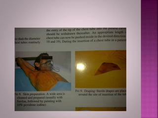 Safe insertion of chest tube | PPTX
