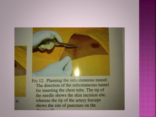 Safe insertion of chest tube | PPTX