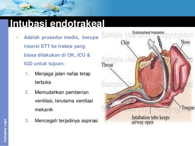 Safe intubation