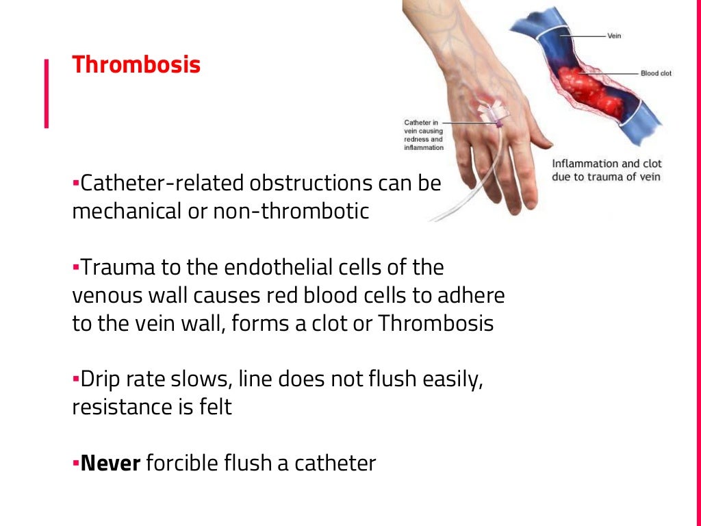 Safe iv cannulation (prevention of iv thrombophlebitis)