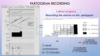 safe labour mangment Labour care guid and partogram.pptx