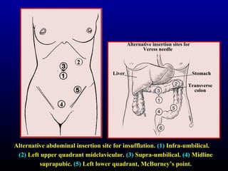 Alternative insertion sites for 
Veress needle 
Liver Stomach 
Transverse 
colon 
2 
4 
Alternative abdominal insertion ssiittee ffoorr iinnssuuffffllaattiioonn.. (11) IInnffrraa--uummbbiilliiccaall.. 
(22) LLeefftt uuppppeerr qquuaaddrraanntt mmiiddccllaavviiccuullaarr.. (33) SSuupprraa--uummbbiilliiccaall.. (44) MMiiddlliinnee 
ssuupprraappuubbiicc.. (55) LLeefftt lloowweerr qquuaaddrraanntt,, MMccBBuurrnneeyy’’ss ppooiinntt.. 
 