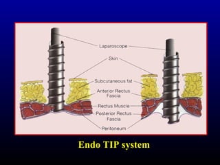 Endo TIP system 
 