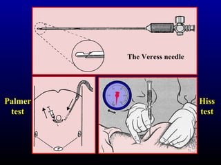 The Veress needle 
HHiissss 
tteesstt 
PPaallmmeerr 
tteesstt 
 