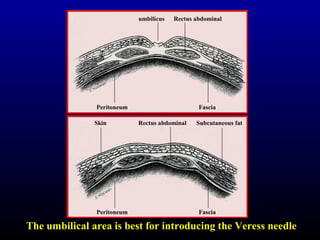 Rectus abdominal 
umbilicus 
Peritoneum Fascia 
Skin Rectus abdominal Subcutaneous fat 
Peritoneum Fascia 
The umbilical area is best for introducing the Veress needle 
 