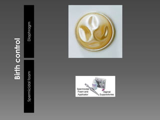 Birth controlDiaphragmSpermicidal foam
