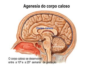 Agenesia do corpo caloso cerebelo O corpo caloso se desenvolve  entre  a 10ª e  a 25ª  semana  de gestação Corpo caloso 