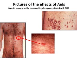Pictures of the effects of Aids
Kaposi's sarcoma on the trunk and leg of a person affected with AIDS
 