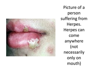Picture of a
    person
suffering from
   Herpes.
 Herpes can
     come
  anywhere
      (not
 necessarily
    only on
    mouth)
 
