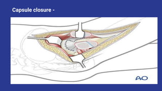 Safe Surgical Dislocation of Hip Joint.pptx