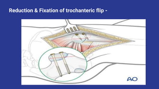 Safe Surgical Dislocation of Hip Joint.pptx
