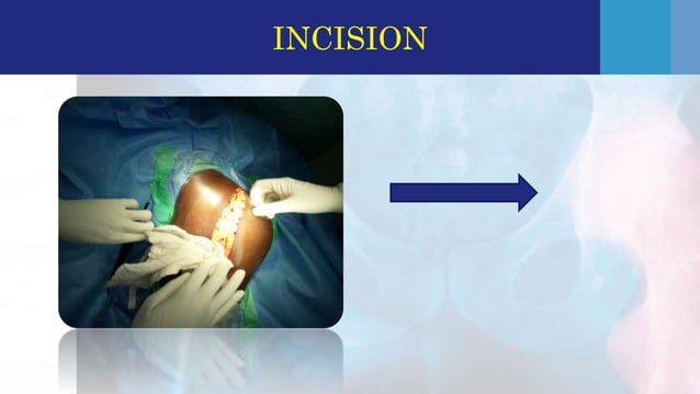 Safe surgical dislocation[ssd] for avascular necrosis hip[ avn] | PPTX ...