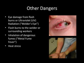 Other Dangers Eye damage from flash burns or Ultraviolet (UV) Radiation (“Welder’s Eye”) Flash burns to the welder or surrounding workers Inhalation of dangerous fumes (“Metal Fume Fever”) Heat stress 