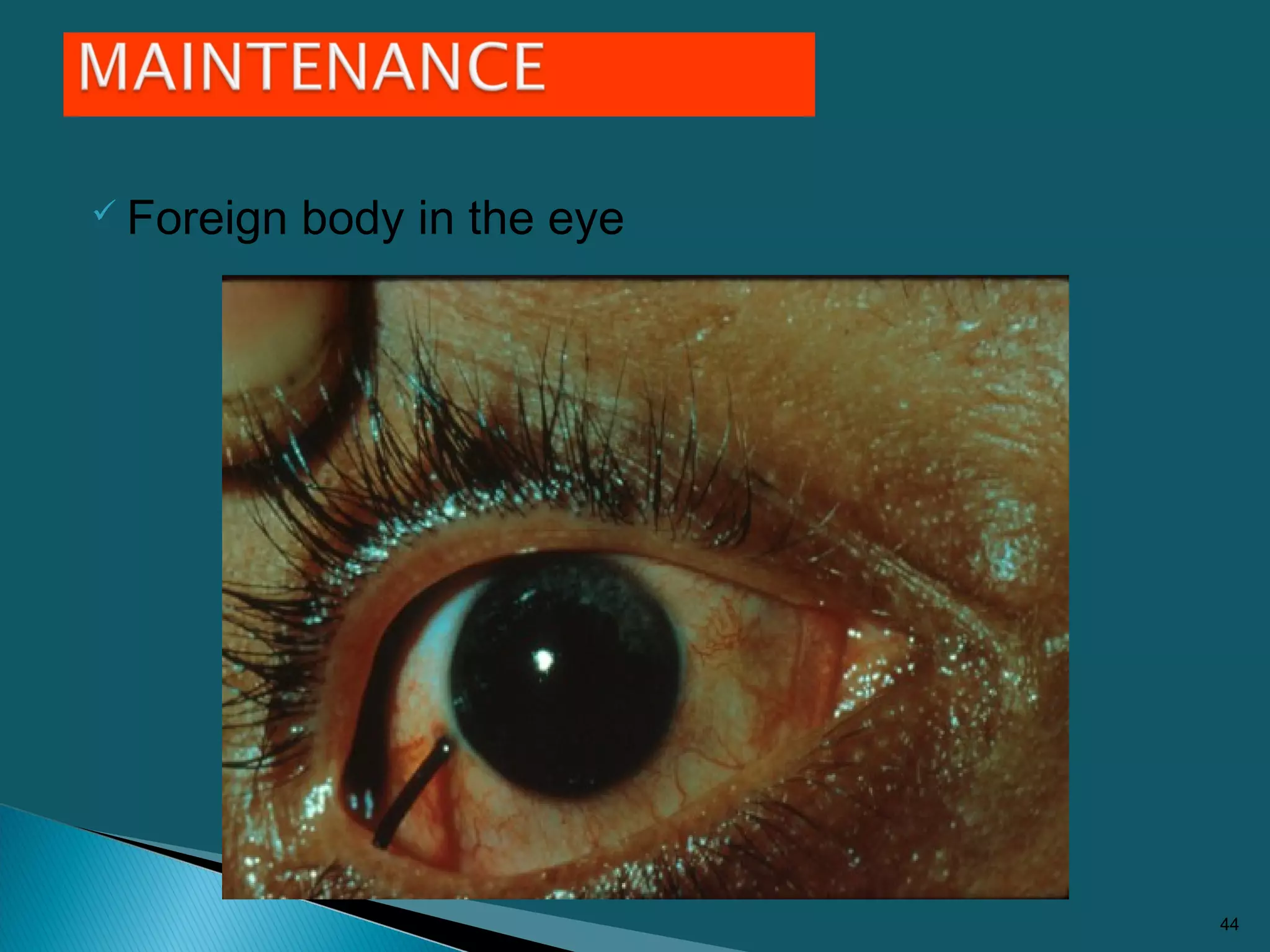  Foreign body in the eye
44
 