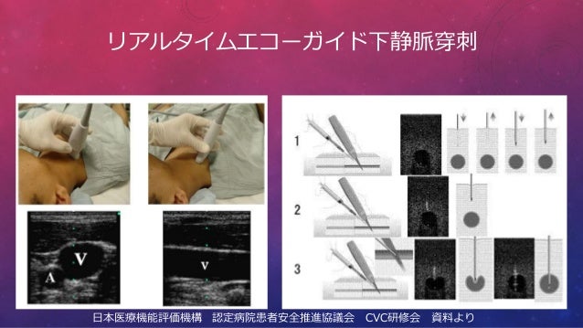 Safety Management For Cvc Insertion