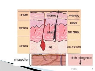 Burn Net Types Comprehensive Overview of Burn Injuries: Types, Depth, and Treatment | PPTX
