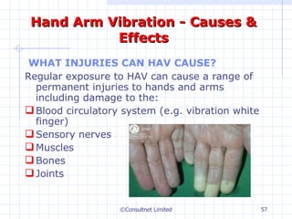 Hand Arm Vibration - Causes & Effects WHAT INJURIES CAN HAV CAUSE? Regular exposure to HAV can cause a range of permanent injuries to hands and arms including damage to the: Blood circulatory system (e.g. vibration white finger) Sensory nerves Muscles Bones Joints ©Consultnet Limited 