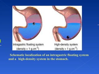     Schematic localization of an intragastric floating system  and a  high-density system in the stomach.          
