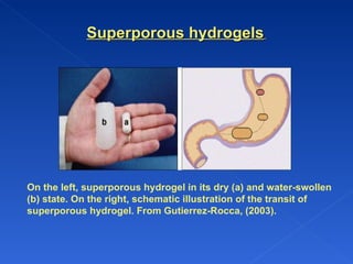 On the left, superporous hydrogel in its dry (a) and water-swollen (b) state. On the right, schematic illustration of the transit of superporous hydrogel. From Gutierrez-Rocca, (2003).  Superporous hydrogels   