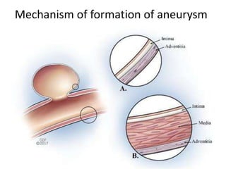Mechanism of formation of aneurysm
 