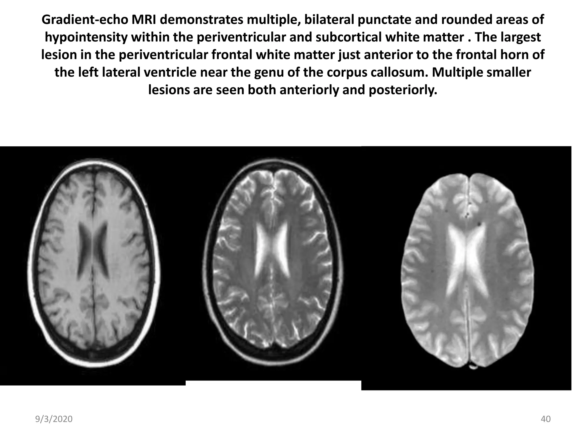 Non traumatic Subarachnoid hemorrhage (SAH) | PPTX