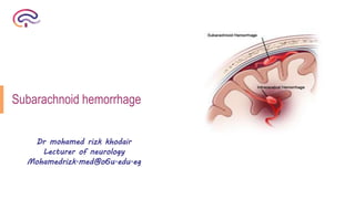 Subarachnoid hemorrhage
Dr mohamed rizk khodair
Lecturer of neurology
Mohamedrizk.med@o6u.edu.eg
 