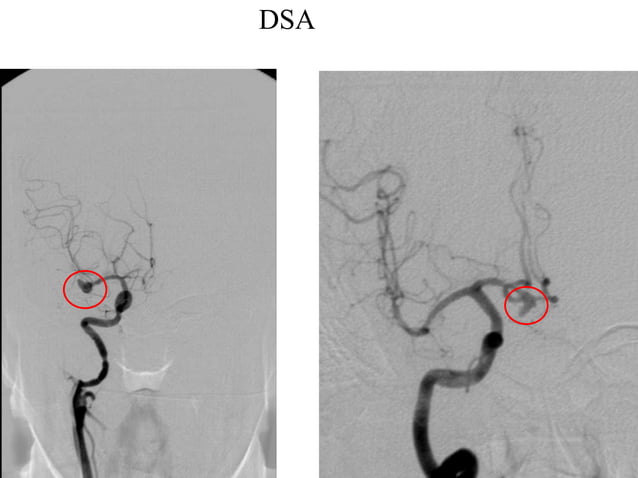 SAH for Neurology Residents | PPT