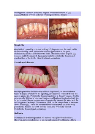 oral hygiene. This site includes a page on correct techniques of oral
hygiene that can prevent and even reverse periodontal disease.
Gingivitis
Gingivitis is caused by a chronic buildup of plaque around the teeth and is
characterized by a red, sometimes swollen appearance of the gums
immediately around the necks of the teeth. It is easily cured by good oral
hygiene, but left untreated, it generally leads to periodontal disease and
eventual loss of the teeth. Gingivitis is not contagious.
Periodontal disease
Outright periodontal disease may effect a single tooth, or any number of
teeth. It begins after about the age of 25, and becomes serious between the
ages of 35 and 50. Periodontal disease is painless in its early stages. It is the
outcome of a lifetime of poor oral hygiene, and begins with simple gingivitis.
In periodontal disease, the gums recede down the roots of the teeth, and the
teeth appear to be longer than normal (click on the image above to see more
about this image). Since the bone that maintains the teeth is effected by
periodontal disease, the teeth become loose, and eventually painful.
Periodontal disease is not contagious.
Halitosis
Bad breath is a chronic problem for persons with periodontal disease.
However, periodontal disease is not the only cause of bad breath, a I have
 