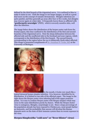 defined by the third branch of the trigeminal nerve. It is outlined in blue to
make it easier to see. Click the image to see larger images, as well as a great
deal more on the concept of somatic dermatomes. Shingles infections are
quite painful, and they generally go away after four or five weeks, but shingles
may reoccur again at a later date. It frequently leaves those so afflicted with
"postherpetic neuralgia" (PHN), which is severely sensitive skin, well
after the infection.
The image below shows the distribution of the herpes zoster rash from the
frontal aspect, this time confined to the distribution of the first and second
branches of the trigeminal nerve. Note the sharp delineation between the
affected side and the unaffected side in the forehead and nose regions, which
corresponds to the distribution of the first branch. The second branch,
corresponding to the region below the eye is billaterally (both sides) affected.
This image is presented compliments of Dr. Jonathan D. Trobe, MD at the
University of Michigan.
In the mouth, it looks very much like a
typical intraoral herpes simplex infection. It is, however, identified by its
distribution. It is limited to one side of the affected organ. The image to the
right shows the Herpes zoster virus infecting half of the upper posterior
palate. It is easy to confuse Herpes zoster with Herpes simplex which may
occur in the same distribution purely by chance. While the Herpes Zoster
virus is contagious, Shingles, surprisingly is not. Since a large percentage of
the population already has been exposed to Chicken pox, most people harbor
an immunity, and the probability that anyone will develop this disease
depends more on the state of their immune system than on recent exposure to
the virus.
Herpes Simplex(the "cold sore" or "fever blister" virus)
 