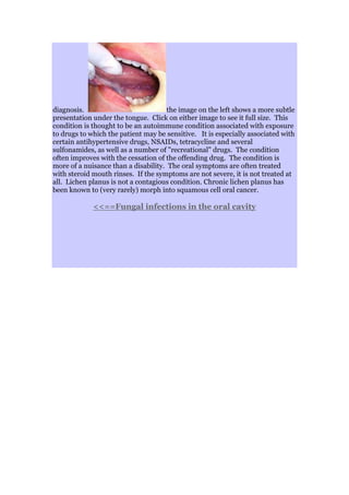diagnosis. the image on the left shows a more subtle
presentation under the tongue. Click on either image to see it full size. This
condition is thought to be an autoimmune condition associated with exposure
to drugs to which the patient may be sensitive. It is especially associated with
certain antihypertensive drugs, NSAIDs, tetracycline and several
sulfonamides, as well as a number of "recreational" drugs. The condition
often improves with the cessation of the offending drug. The condition is
more of a nuisance than a disability. The oral symptoms are often treated
with steroid mouth rinses. If the symptoms are not severe, it is not treated at
all. Lichen planus is not a contagious condition. Chronic lichen planus has
been known to (very rarely) morph into squamous cell oral cancer.
<<==Fungal infections in the oral cavity
 