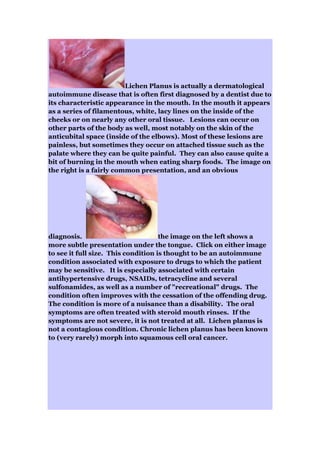 Lichen Planus is actually a dermatological
autoimmune disease that is often first diagnosed by a dentist due to
its characteristic appearance in the mouth. In the mouth it appears
as a series of filamentous, white, lacy lines on the inside of the
cheeks or on nearly any other oral tissue. Lesions can occur on
other parts of the body as well, most notably on the skin of the
anticubital space (inside of the elbows). Most of these lesions are
painless, but sometimes they occur on attached tissue such as the
palate where they can be quite painful. They can also cause quite a
bit of burning in the mouth when eating sharp foods. The image on
the right is a fairly common presentation, and an obvious
diagnosis. the image on the left shows a
more subtle presentation under the tongue. Click on either image
to see it full size. This condition is thought to be an autoimmune
condition associated with exposure to drugs to which the patient
may be sensitive. It is especially associated with certain
antihypertensive drugs, NSAIDs, tetracycline and several
sulfonamides, as well as a number of "recreational" drugs. The
condition often improves with the cessation of the offending drug.
The condition is more of a nuisance than a disability. The oral
symptoms are often treated with steroid mouth rinses. If the
symptoms are not severe, it is not treated at all. Lichen planus is
not a contagious condition. Chronic lichen planus has been known
to (very rarely) morph into squamous cell oral cancer.
 