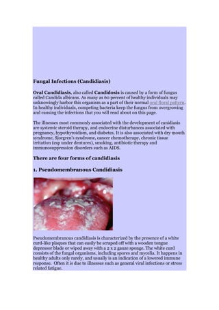 Fungal Infections (Candidiasis)
Oral Candidiasis, also called Candidosis is caused by a form of fungus
called Candida albicans. As many as 60 percent of healthy individuals may
unknowingly harbor this organism as a part of their normal oral floral pattern.
In healthy individuals, competing bacteria keep the fungus from overgrowing
and causing the infections that you will read about on this page.
The illnesses most commonly associated with the development of canidiasis
are systemic steroid therapy, and endocrine disturbances associated with
pregnancy, hypothyroidism, and diabetes. It is also associated with dry mouth
syndrome, Sjorgren's syndrome, cancer chemotherapy, chronic tissue
irritation (esp under dentures), smoking, antibiotic therapy and
immunosuppression disorders such as AIDS.
There are four forms of candidiasis
1. Pseudomembranous Candidiasis
Pseudomembranous candidiasis is characterized by the presence of a white
curd-like plaques that can easily be scraped off with a wooden tongue
depressor blade or wiped away with a 2 x 2 gauze sponge. The white curd
consists of the fungal organisms, including spores and mycelia. It happens in
healthy adults only rarely, and usually is an indication of a lowered immune
response. Often it is due to illnesses such as general viral infections or stress
related fatigue.
 