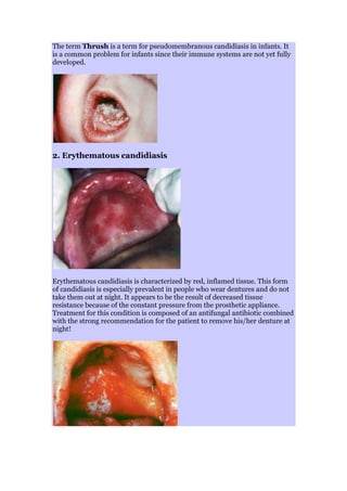 The term Thrush is a term for pseudomembranous candidiasis in infants. It
is a common problem for infants since their immune systems are not yet fully
developed.
2. Erythematous candidiasis
Erythematous candidiasis is characterized by red, inflamed tissue. This form
of candidiasis is especially prevalent in people who wear dentures and do not
take them out at night. It appears to be the result of decreased tissue
resistance because of the constant pressure from the prosthetic appliance.
Treatment for this condition is composed of an antifungal antibiotic combined
with the strong recommendation for the patient to remove his/her denture at
night!
 