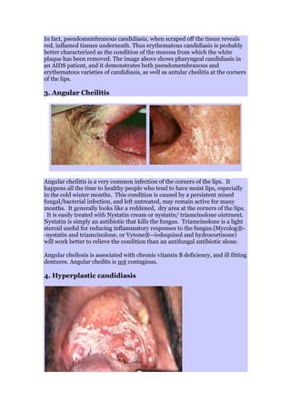 In fact, pseudomembranous candidiasis, when scraped off the tissue reveals
red, inflamed tissues underneath. Thus erythematous candidiasis is probably
better characterized as the condition of the mucosa from which the white
plaque has been removed. The image above shows pharyngeal candidiasis in
an AIDS patient, and it demonstrates both pseudomembranous and
erythematous varieties of candidiasis, as well as antular cheilitis at the corners
of the lips.
3. Angular Cheilitis
Angular cheilitis is a very common infection of the corners of the lips. It
happens all the time to healthy people who tend to have moist lips, especially
in the cold winter months. This condition is caused by a persistent mixed
fungal/bacterial infection, and left untreated, may remain active for many
months. It generally looks like a reddened, dry area at the corners of the lips.
It is easily treated with Nystatin cream or nystatin/ triamcinolone ointment.
Nystatin is simply an antibiotic that kills the fungus. Triamcinolone is a light
steroid useful for reducing inflammatory responses to the fungus.(Mycolog®-
-nystatin and triamcinolone, or Vytone®--iodoquinol and hydrocortisone)
will work better to relieve the condition than an antifungal antibiotic alone.
Angular cheilosis is associated with chronic vitamin B deficiency, and ill fitting
dentures. Angular cheilits is not contagious.
4. Hyperplastic candidiasis
 