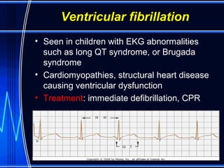Ventricular fibrillation
• Seen in children with EKG abnormalities
such as long QT syndrome, or Brugada
syndrome
• Cardiomyopathies, structural heart disease
causing ventricular dysfunction
• Treatment: immediate defibrillation, CPR
 