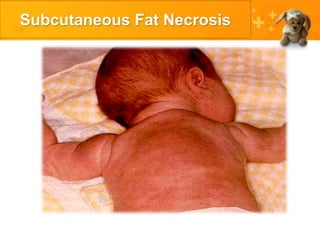 Subcutaneous Fat Necrosis
 