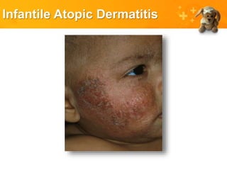 Infantile Atopic Dermatitis
 