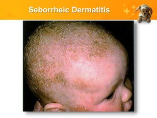 Seborrheic Dermatitis
 