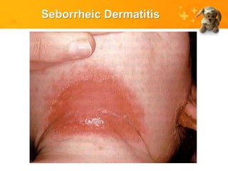 Seborrheic Dermatitis
 