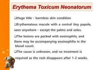 Erythema Toxicum Neonatorum
Huge title - harmless skin condition
Erythematous macule with a central tiny papule,
seen anywhere - except the palms and soles.
The lesions are packed with eosinophils, and
there may be accompanying eosinophilia in the
blood count.
The cause is unknown, and no treatment is
required as the rash disappears after 1-2 weeks.
.
 