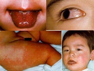 Common pediatric skin rash