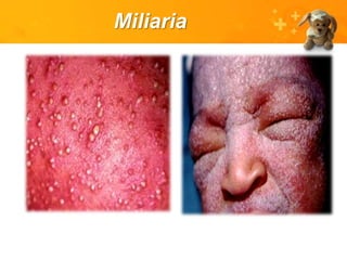 Miliaria
 