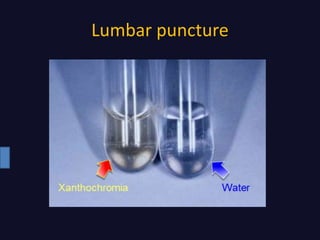Lumbar puncture
 