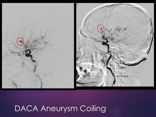 DACA Aneurysm Coiling
 