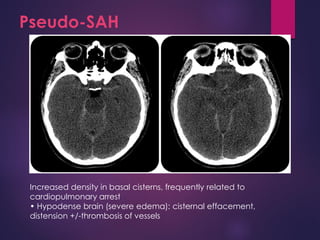 Pseudo-SAH
Increased density in basal cisterns, frequently related to
cardiopulmonary arrest
• Hypodense brain (severe edema): cisternal effacement,
distension +/-thrombosis of vessels
 